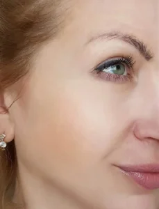 anti-aging-after1