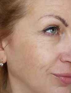 anti-aging-before